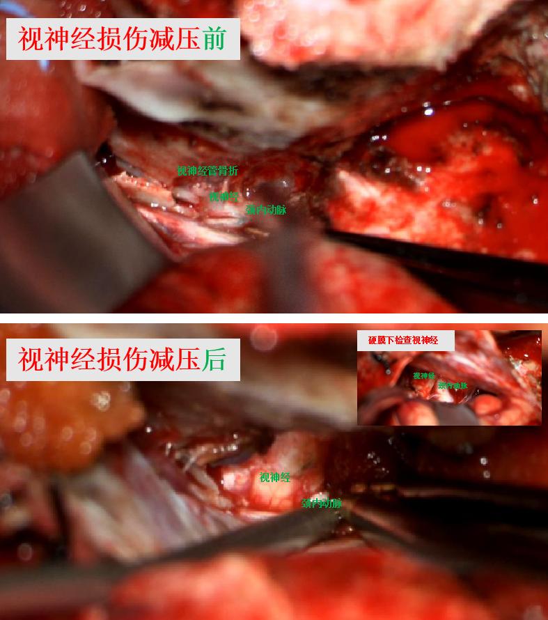 车祸视神经压迫失明的恢复几率,车祸视神经损伤中医针灸成功案例