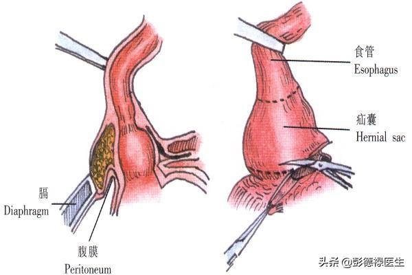 食管胃动力异常,食管动力障碍吞咽困难