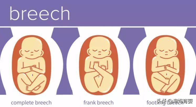 胎位什么时候能固定,怀双胞胎一般几周胎位开始固定