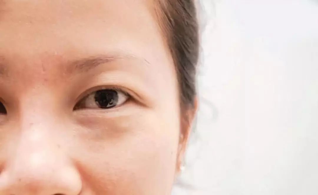 40岁消除眼皮浮肿和眼袋,眼袋怎么消除改善大眼袋