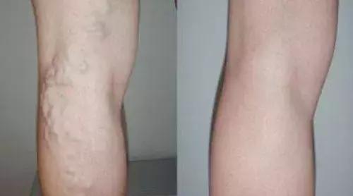 腿上有蚯蚓纹怎么回事,腿上出现蚯蚓似的纹路是怎么回事