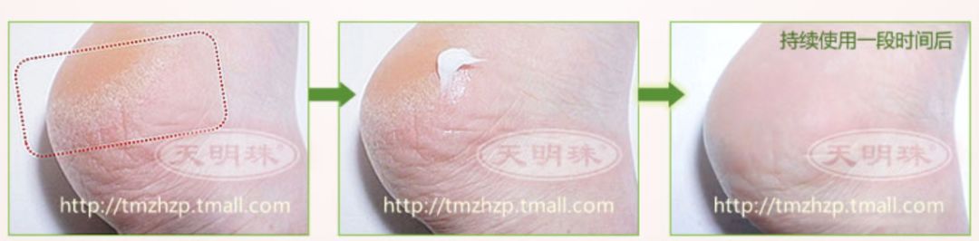 冬季皲裂膏预防脚后跟干裂好用的,上热门脚后跟干裂保湿霜