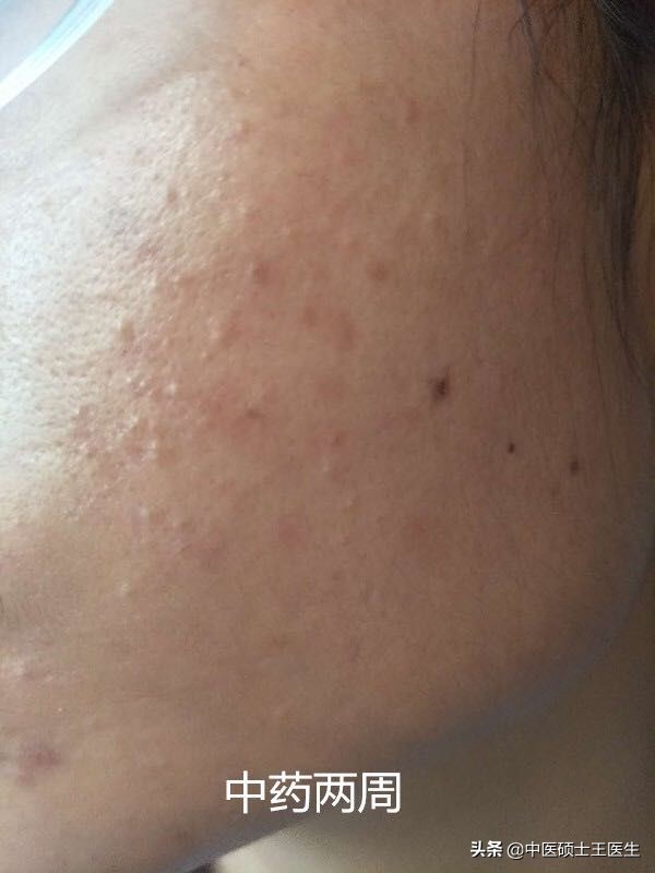 中医祛痘多少钱,中医祛痘挂什么科