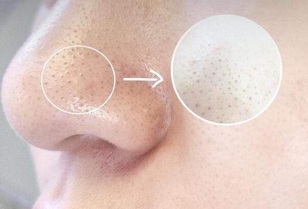 脸部冒出“脓包性痘痘”，想痘痘消失不留疤，经常做3事改善困扰