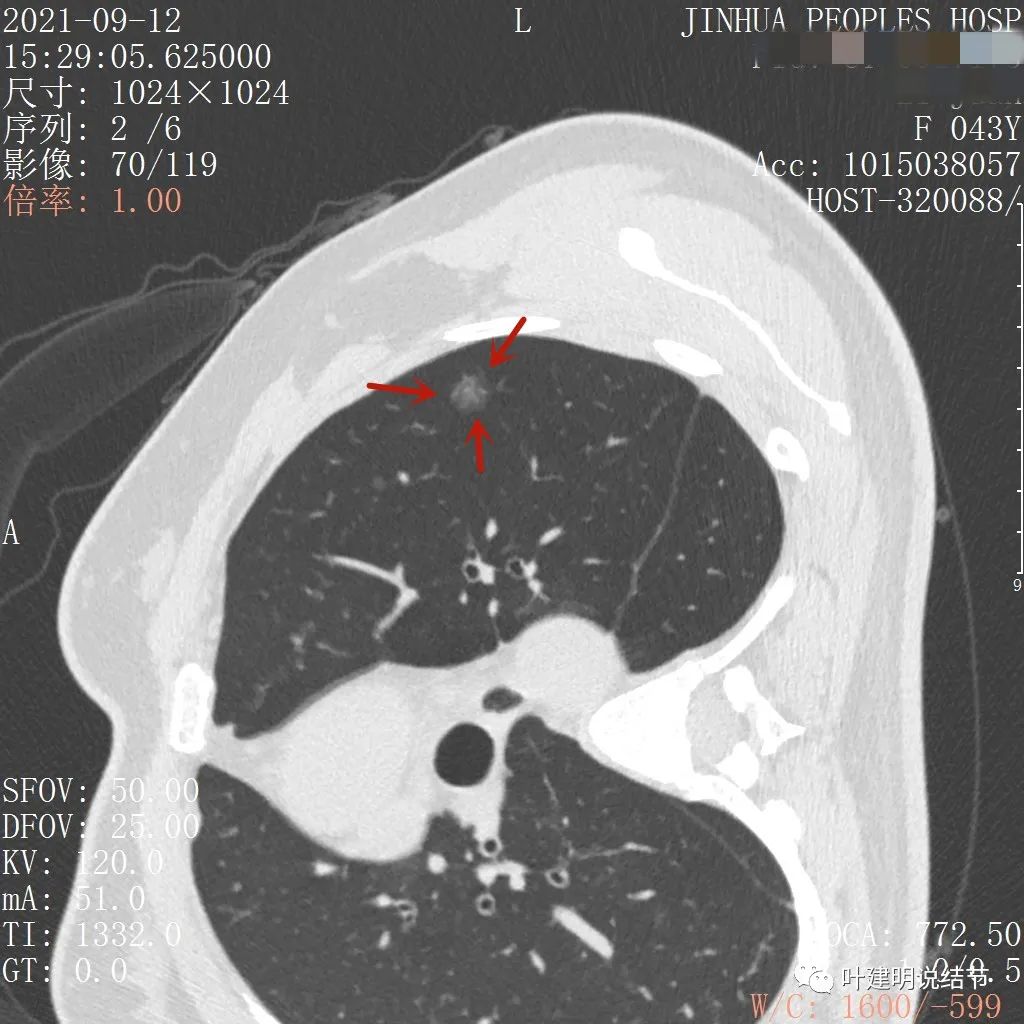 从活检怎么看是非小细胞癌,从病例谈辨证论治