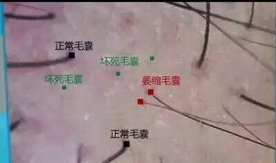 脱发头发不长什么原因,脱发头发生长缓慢是缺啥微量元素