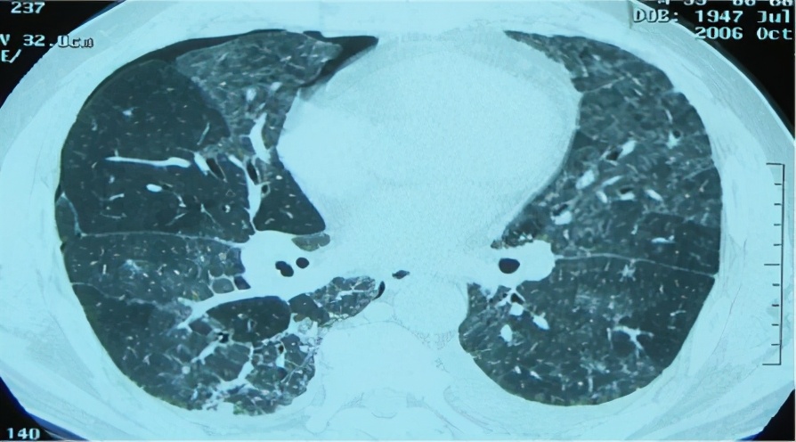 养鸽子造成皮肤真菌感染,养鸽子会得肺炎吗