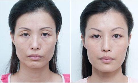 光了嫩肤后皮肤会变光滑吗,皮肤黑光子嫩肤10天变化图片