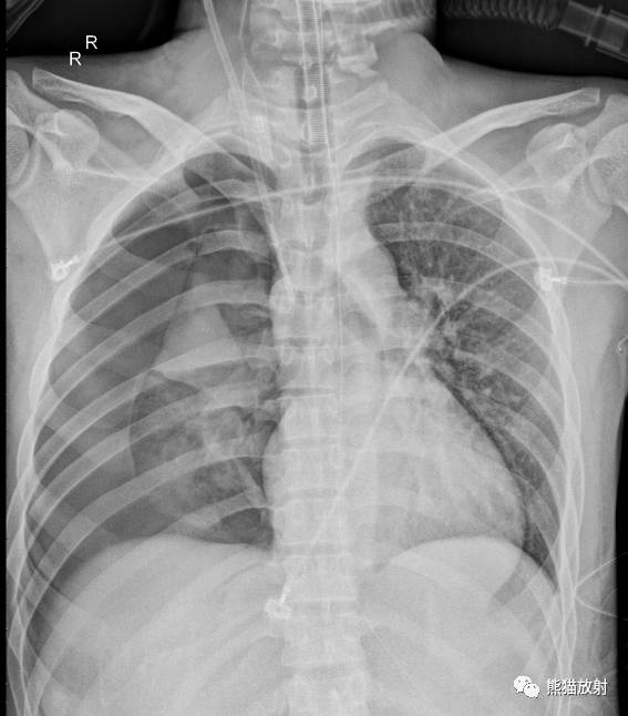 x线诊断边界模糊,x线诊断有误区吗