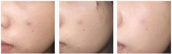 痘肌精华推荐祛痘印学生,油痘肌好用的祛痘精华推荐