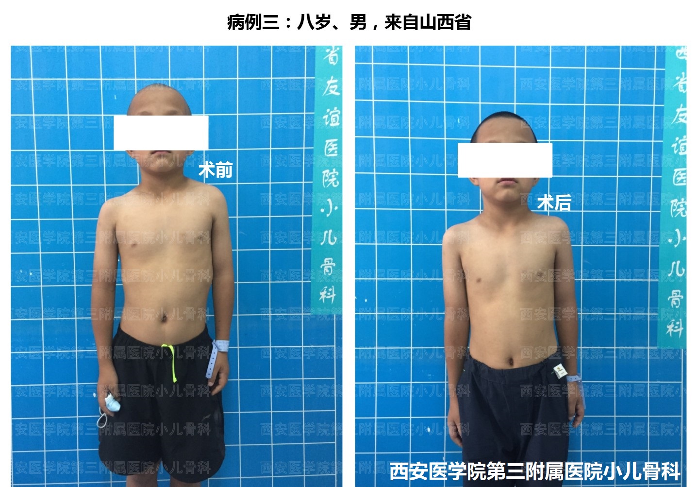 先天性高肩胛手术,先天性肩胛症通过手术需要多少钱