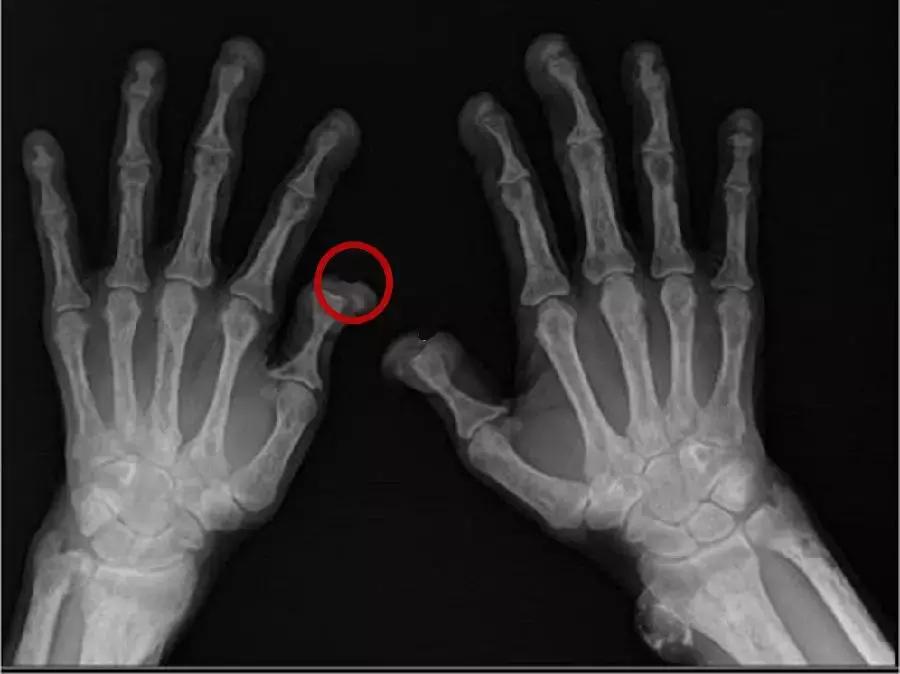 透析病人肌酐急速上升为什么,透析三次肌酐从1100降到500多