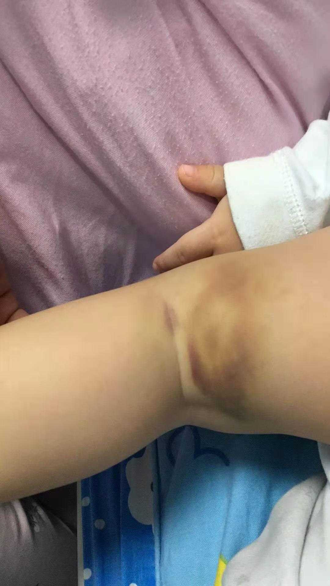 冷凝集素综合征是遗传性的吗,冷凝集素综合征夏季发作吗