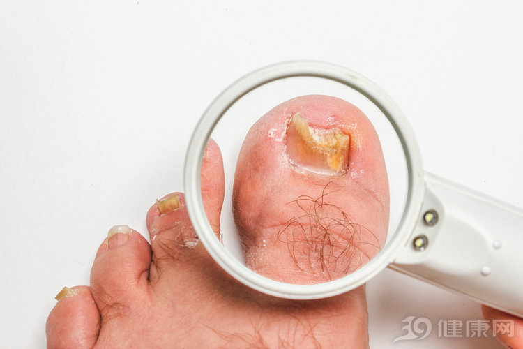 嵌甲旁边长了一小坨肉是怎么回事,脚趾甲老往肉里长会有什么结果