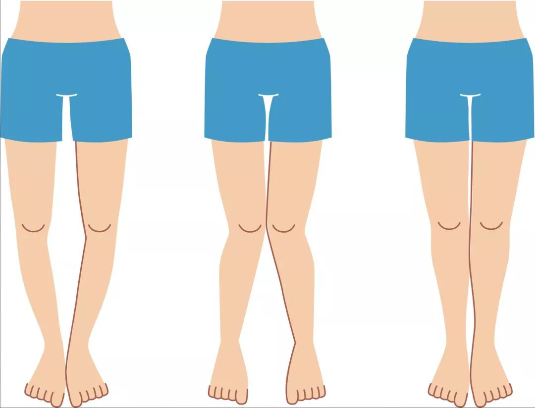 o型腿和x型腿对健康的危害,造成o型腿和x型腿的原因