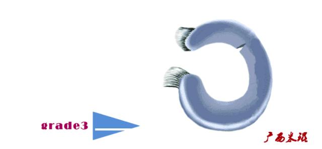 有关半月板的疾病与治疗,听骨科医生讲的话