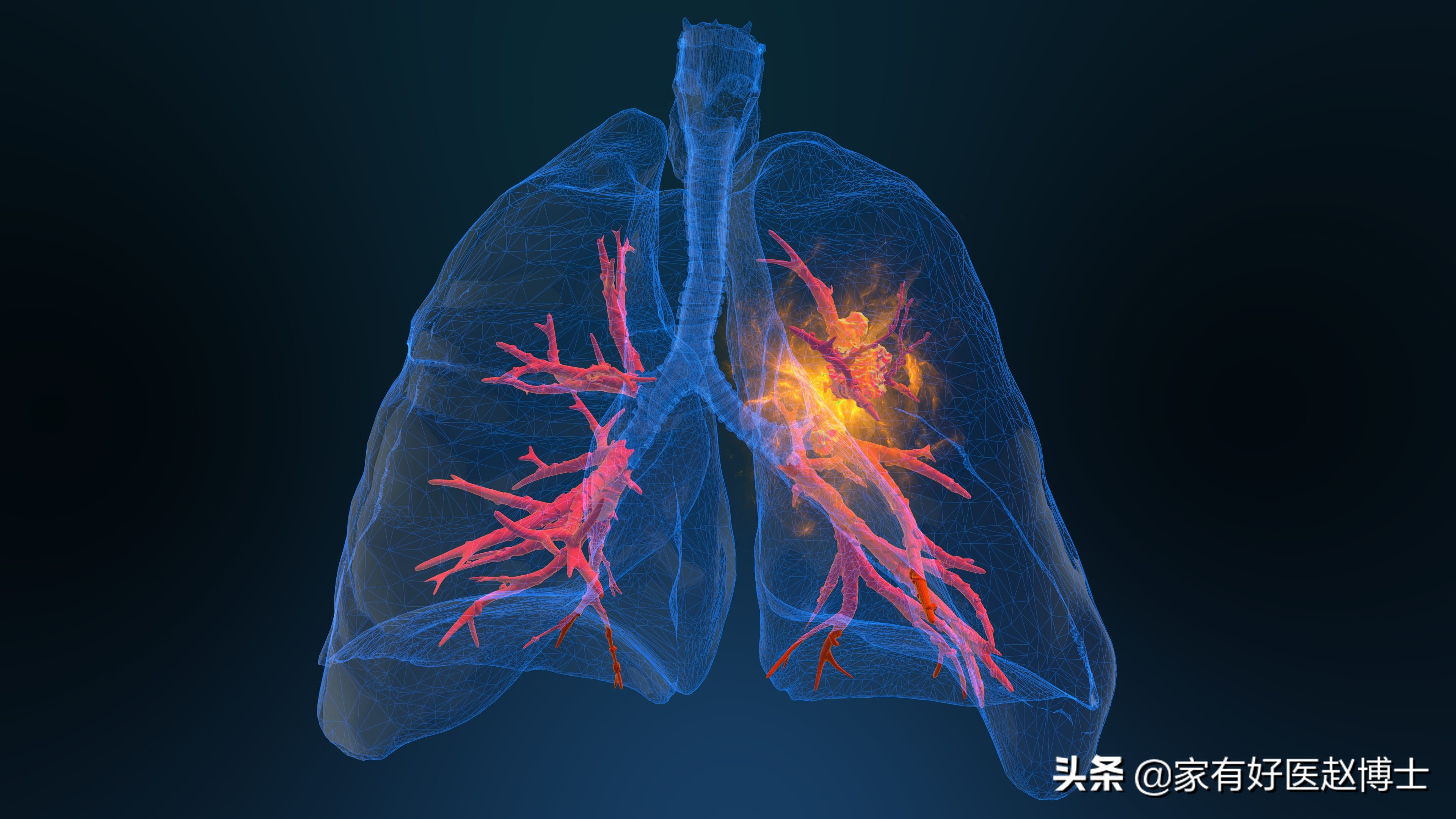 六大高发癌症早筛攻略,六大癌症有哪些