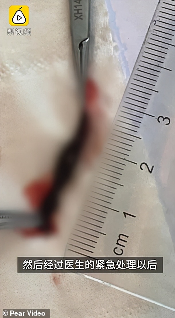 男孩被蚂蚁吓死,蚂蝗寄生在五岁男孩身体里一年