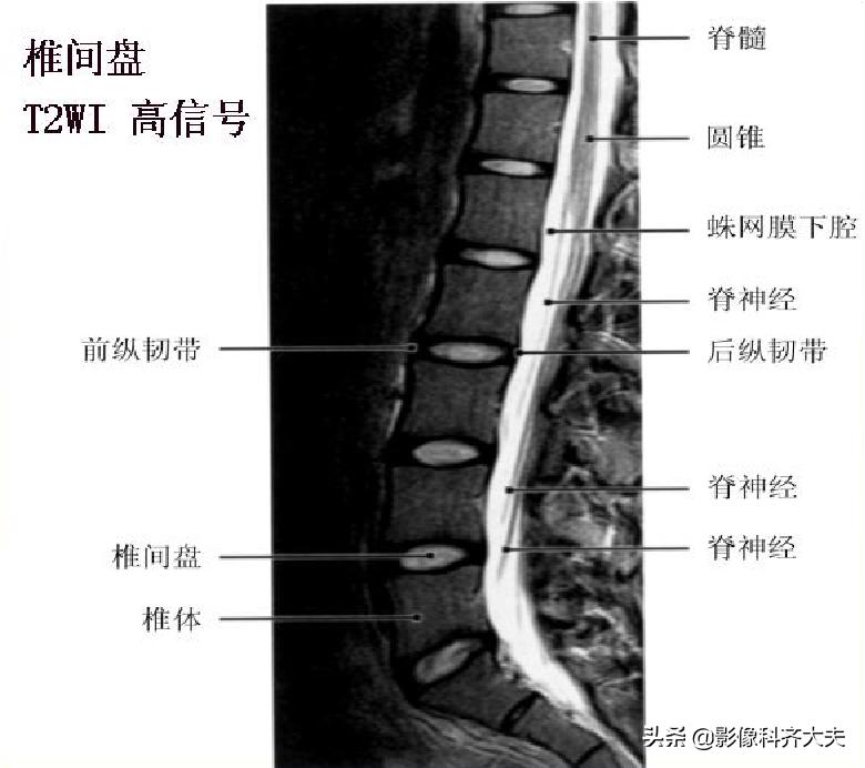 腰椎间盘突出的影像学诊断及治疗,腰椎间盘突出影像学课件