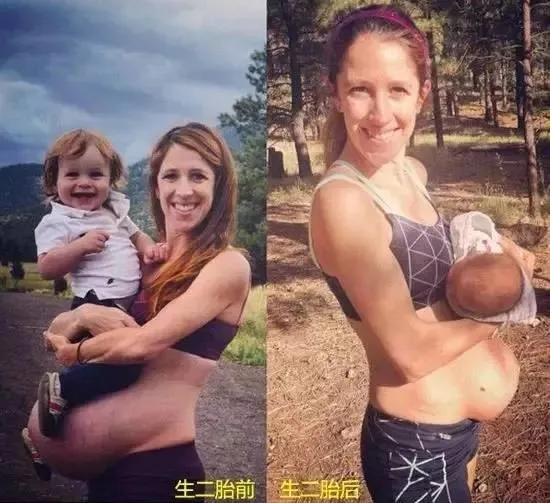 腹部训练腹直肌分离腰痛,腹直肌分离会引起腰痛吗