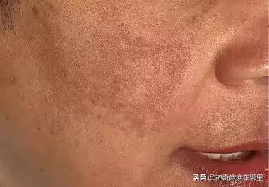 为什么用美白精华皮肤变白,为什么用了美白护肤品反而变黑了