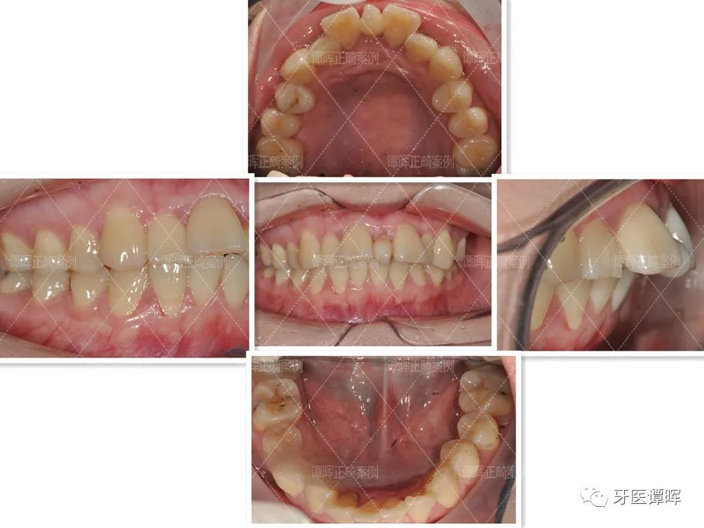 门牙前突+牙齿不齐矫正案例分享