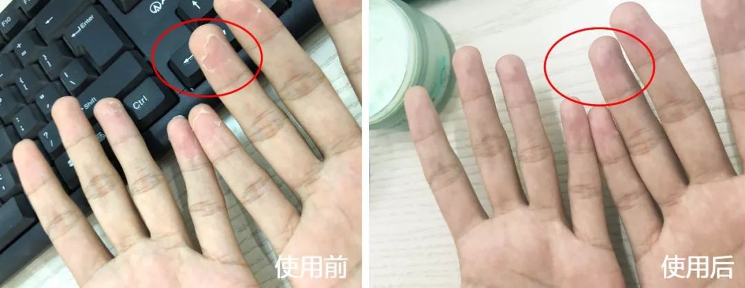 手脚干裂倒刺怎么治疗,手脚经常脱皮开裂最佳治疗方法