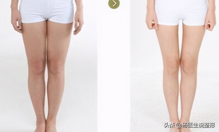 吸脂手术有哪几种类型,吸脂手术很微创