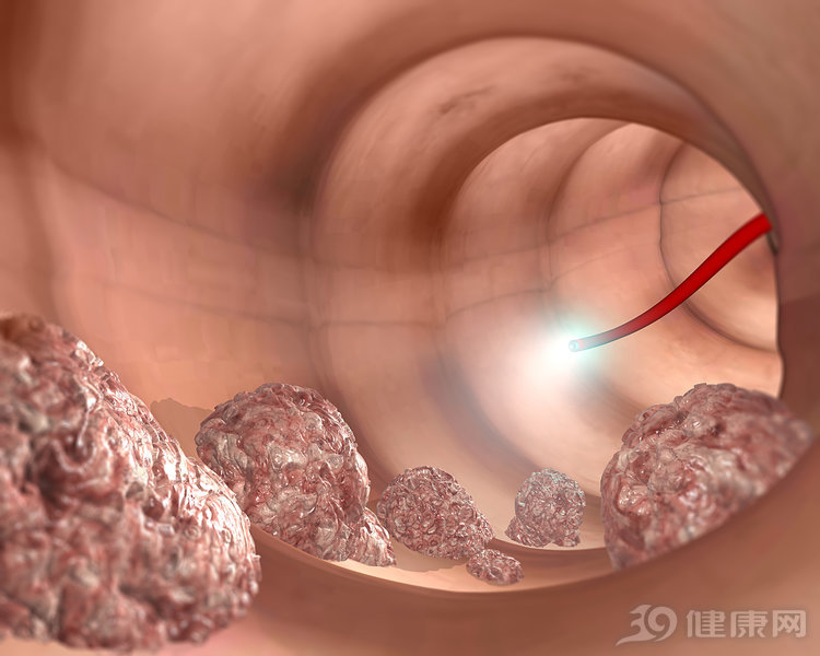 有什么症状需要去做肠镜,身体出现4种症状该做肠镜检查了