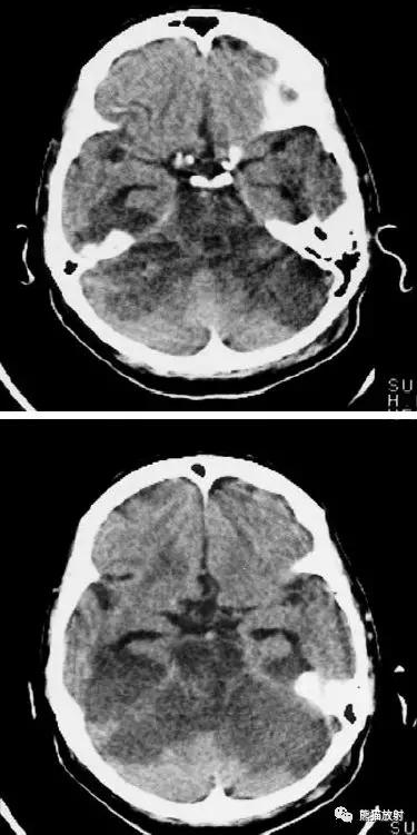 各部位脑梗死ct影像讲解,脑梗死ct影像最简单的是什么表现