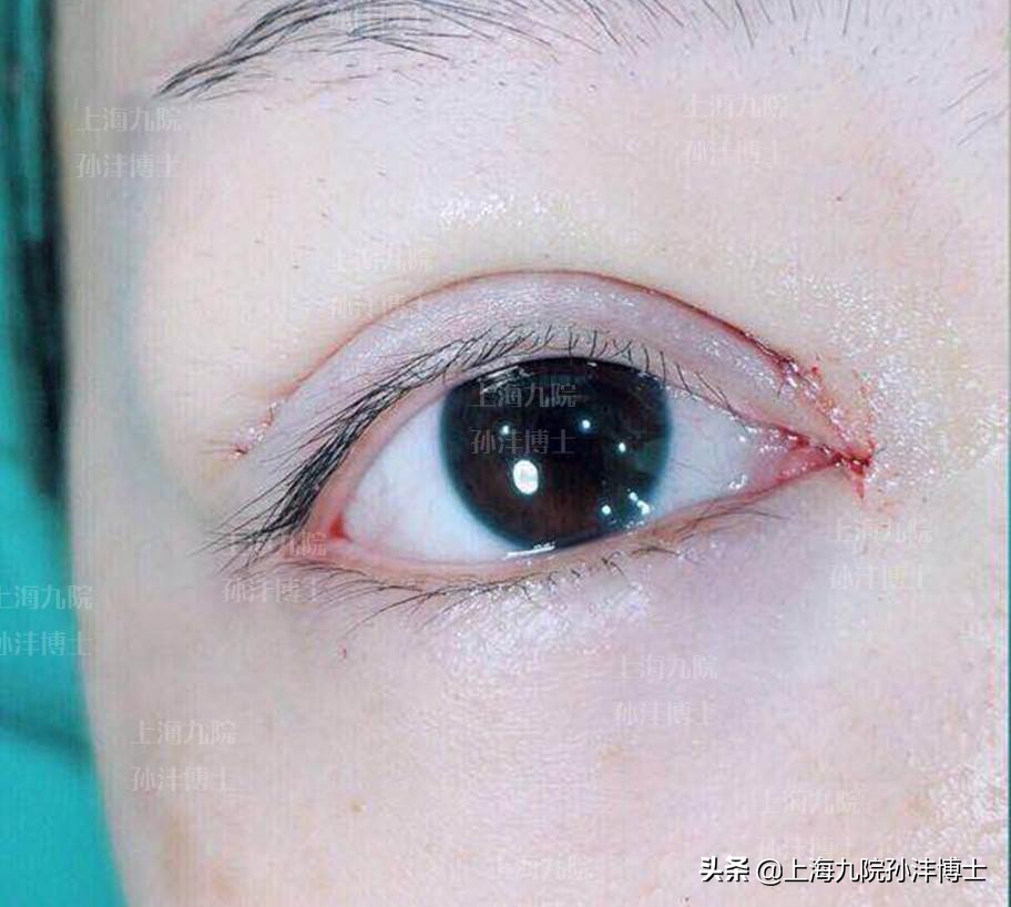 上海九院孙沣博士眼角修复,眼修复能找原来医生修复吗
