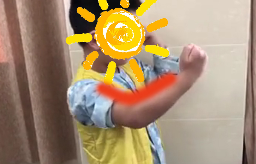 六岁儿童左肘关节骨折胳膊伸不直,六岁孩子肘关节错位复位后伸不直