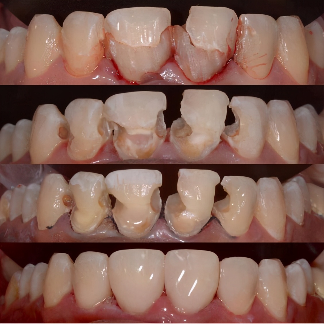 牙齿缺损粘接修复术和简单填充术,牙科义齿修复零基础教学