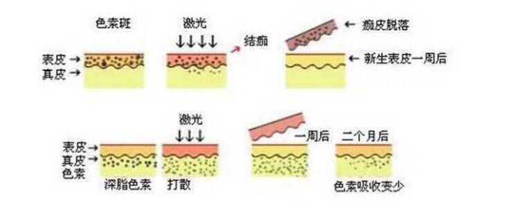 脸上雀斑越来越多怎么调理,脸上雀斑的原因与调理
