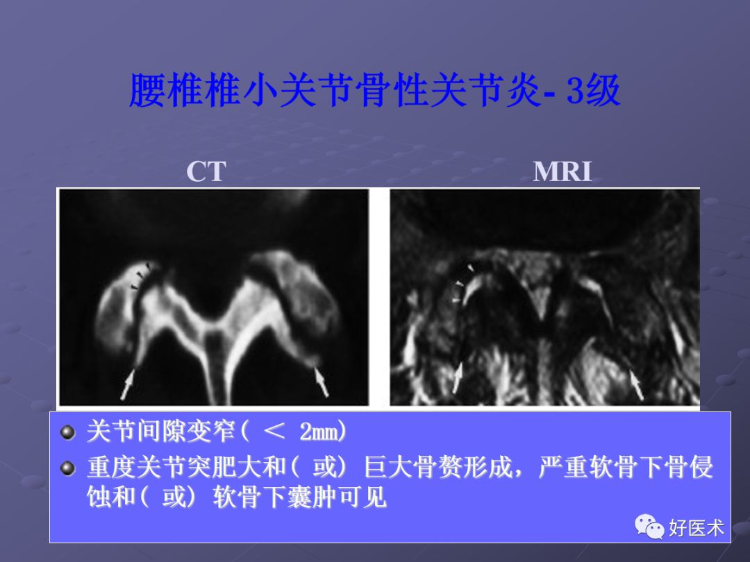 脊柱mri有哪些特点,乳腺疾病的mri诊断及鉴别