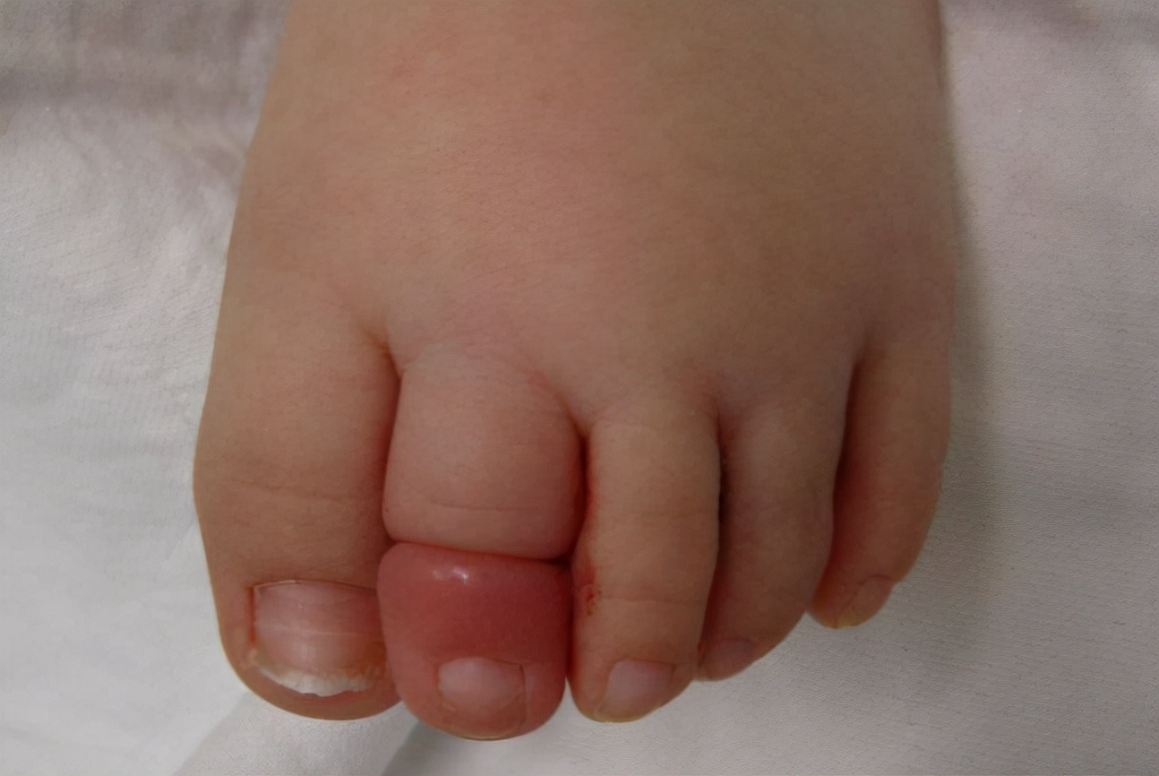 婴儿胳膊突然肿了,宝宝手臂肿了一块鼓起来