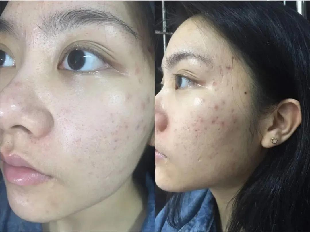 片仔癀祛痘痘产品,片仔癀可以改善痘痘肌吗