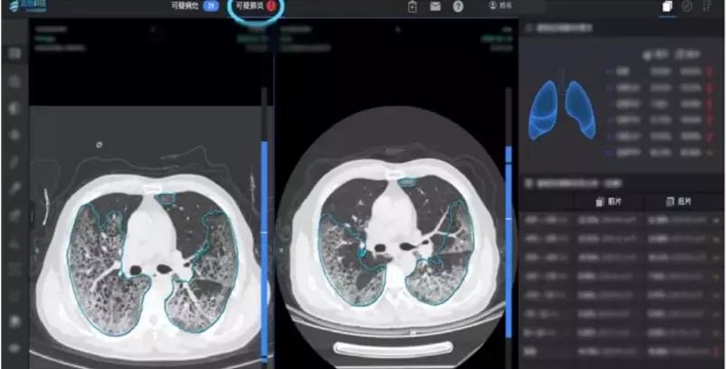 CT+AI双拳出击攻破“假阴性”困境：上线当天即实现确诊｜AI战疫