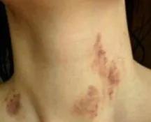 宝妈满脖子“草莓”去接孩子放学,被大娘追问是不是上火