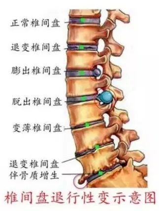 腰椎间盘突出坐骨神经痛如何缓解,腰椎间盘突出脚痛神经痛怎么缓解