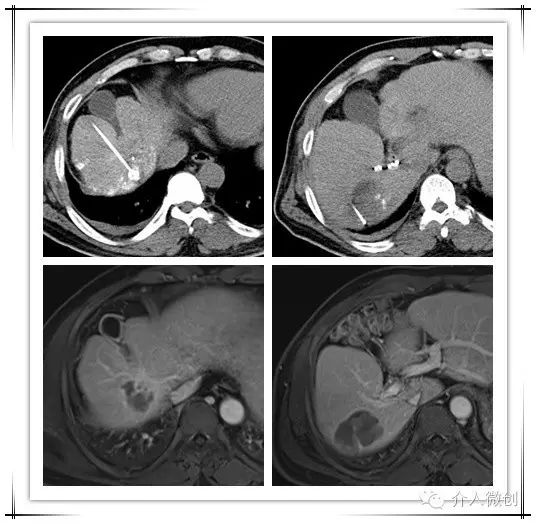 肝癌门静脉癌栓能做介入手术吗,肝癌门静脉癌栓中医治疗