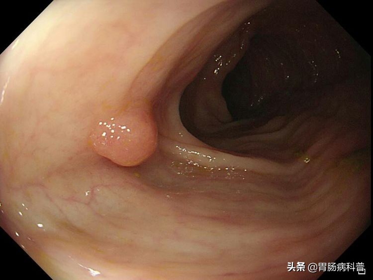 结肠癌会代代相传吗,结肠癌肝转移