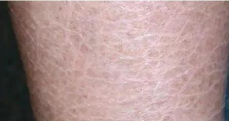 脚干裂脱皮鱼鳞状,脚后跟干裂起鱼鳞怎么治