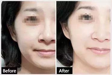 果酸可以根治闭口吗,果酸去闭口可以天天用吗