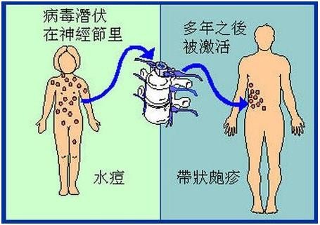 带状疱疹为什么痛不欲生,让人疼痛难忍的带状疱疹