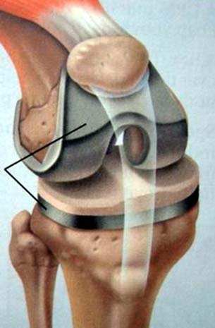 膝盖关节炎骨刺用什么药缓解疼痛,受冷膝盖长骨刺能治好吗