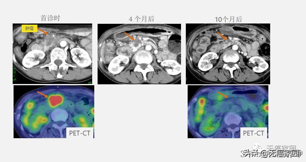 质子治疗手术适合大型肿瘤,肿瘤不能根治吗