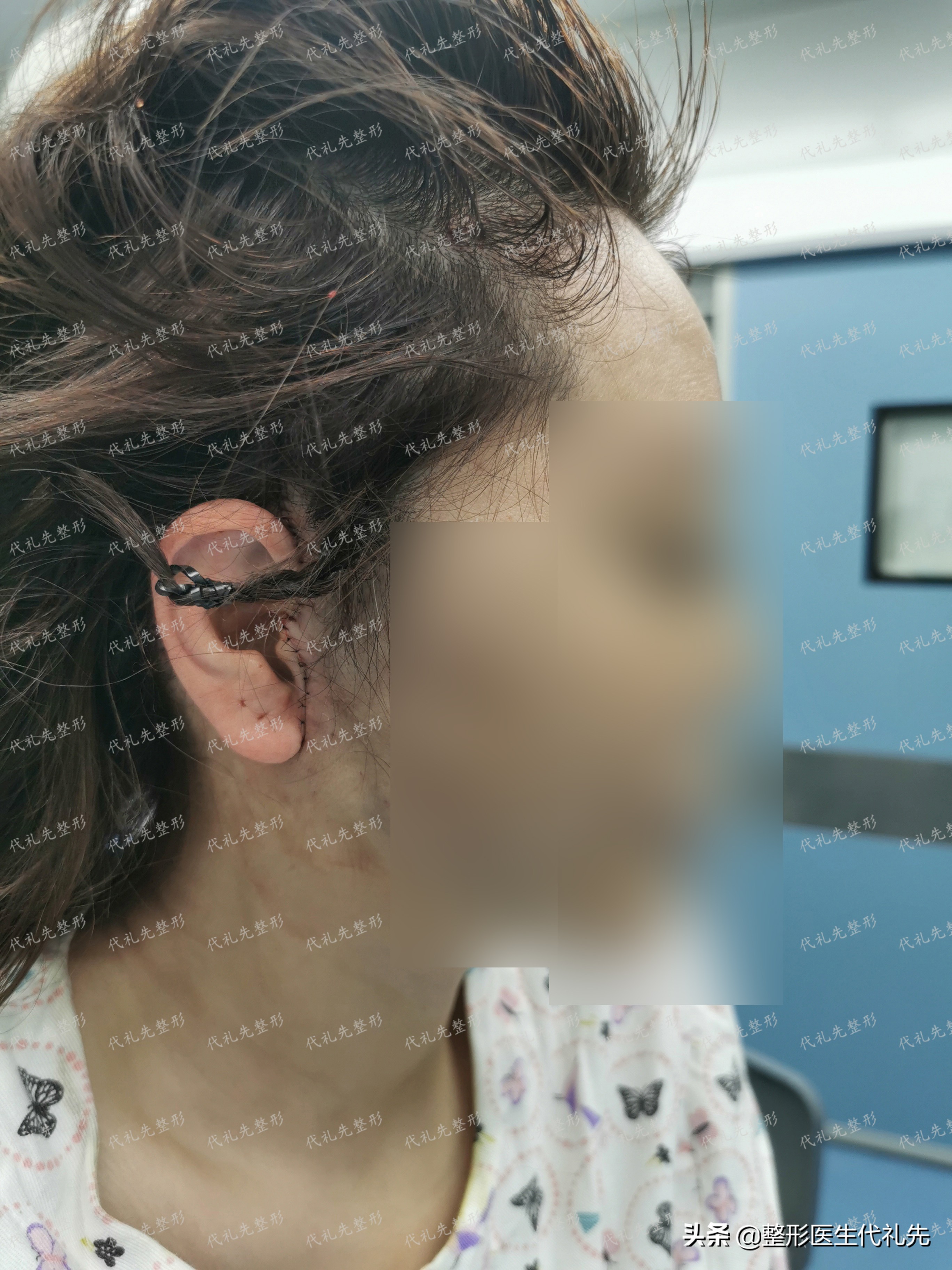 拉皮手术拆线后的护理,拉皮没有拆线前几天伤口换药