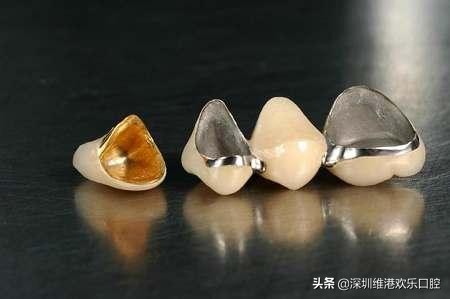 烤瓷牙与全瓷牙的差别，不同品牌对比
