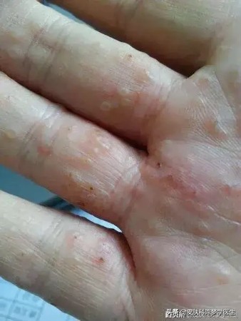 一到春天手痒起水泡怎么回事,一到春天手上密密麻麻起水泡疼